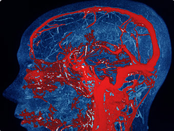 Cerebrovascular Program